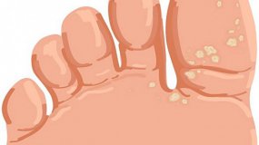 Признаки бородавок на ноге